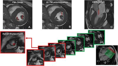 Cardiovascular magnetic resonance insights into anomalies of the mitral valve apparatus in Fabry cardiomyopathy and hypertrophic cardiomyopathy